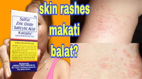 allergy sa sabon panlaba|Mga Kundisyon at Sakit sa Balat na Nagdudulot ng .